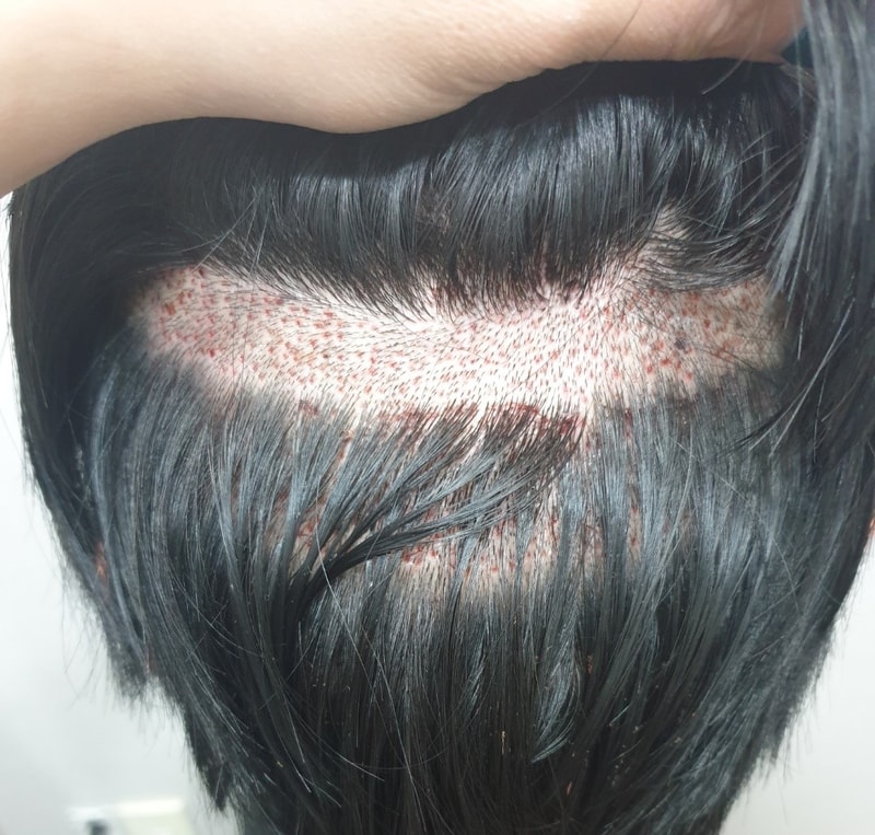 수술직후 뒷통수올린거cp.jpg
