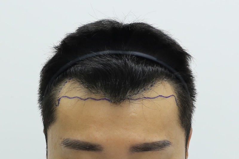 3. 수술 전 디자인.jpg