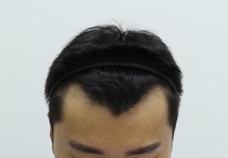 2. 수술 전.jpg