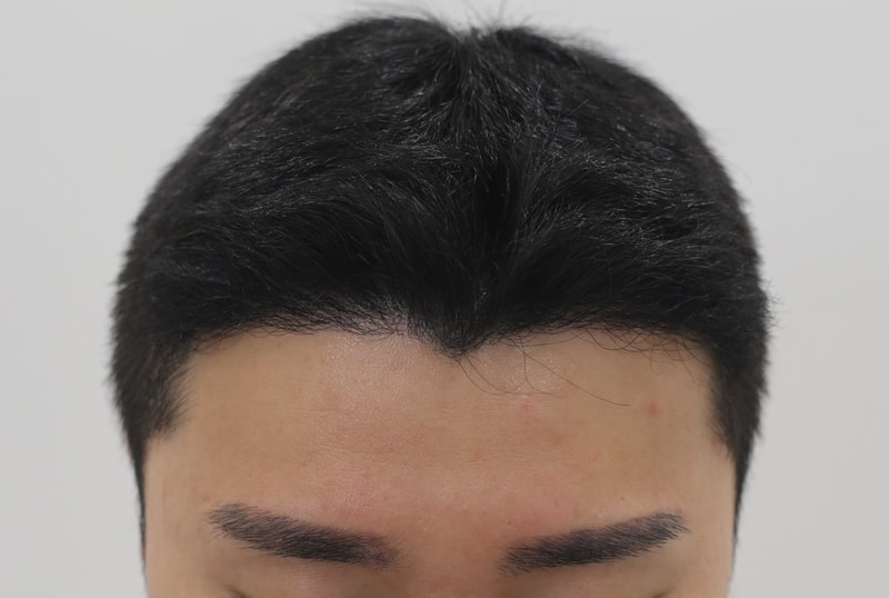 압구정 맘모스 7개월 모발이식 후기. 최고급 슬릿 장비로 머리가 빨리 올라왔다합니다.