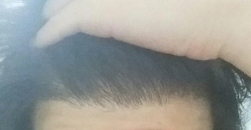 Motion March 10th 800 Hair follicles 8 Months Late