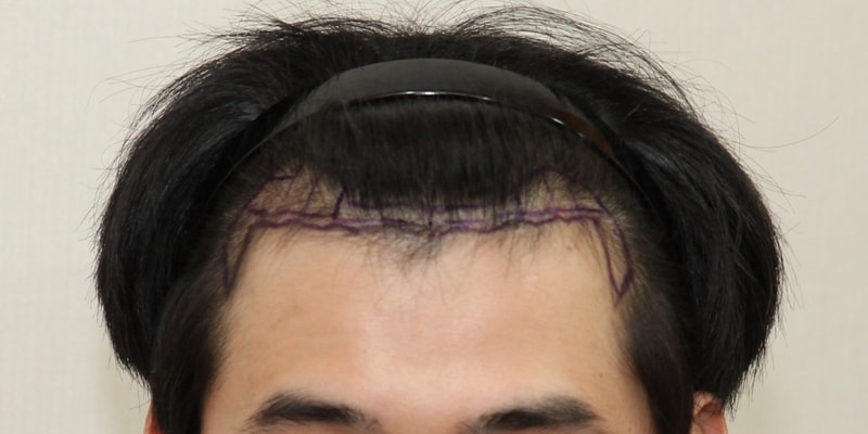 수술 전 앞머리.png