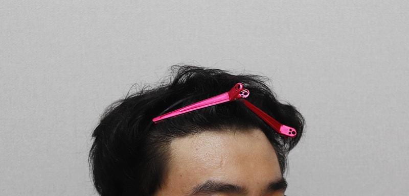 이식6개월후.JPG