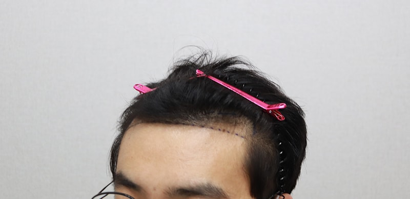 이식전1.JPG