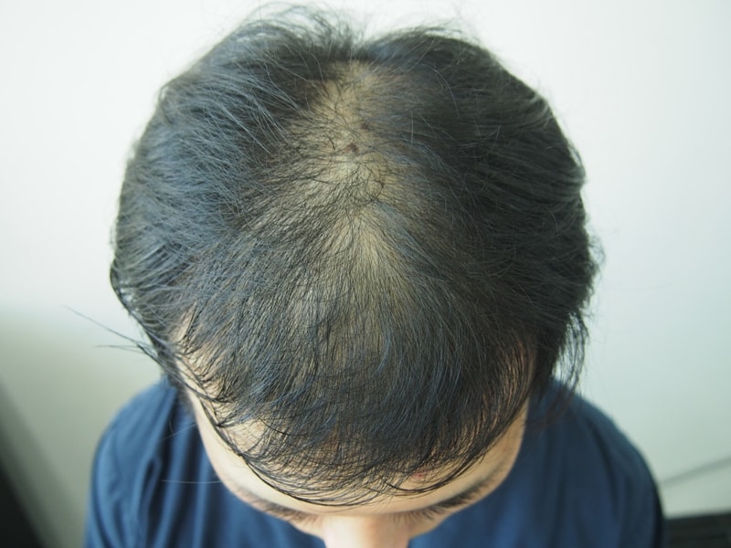 모재성 정수리 이식 4개월 평가입니다.