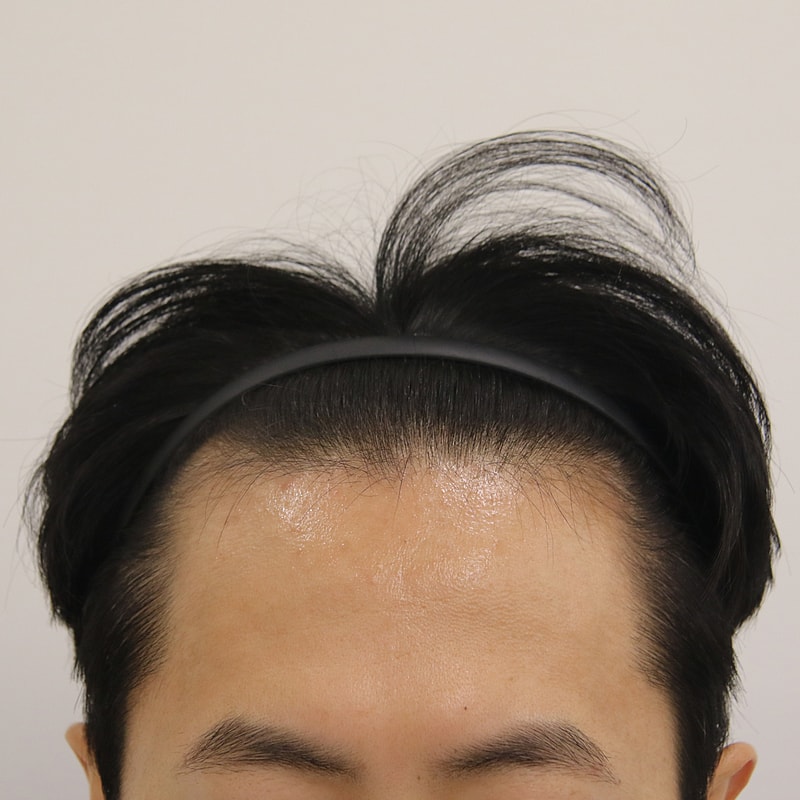 Busan Mammoth Hairline Clinic Non-Cutted Hair Transplantation after 14 days