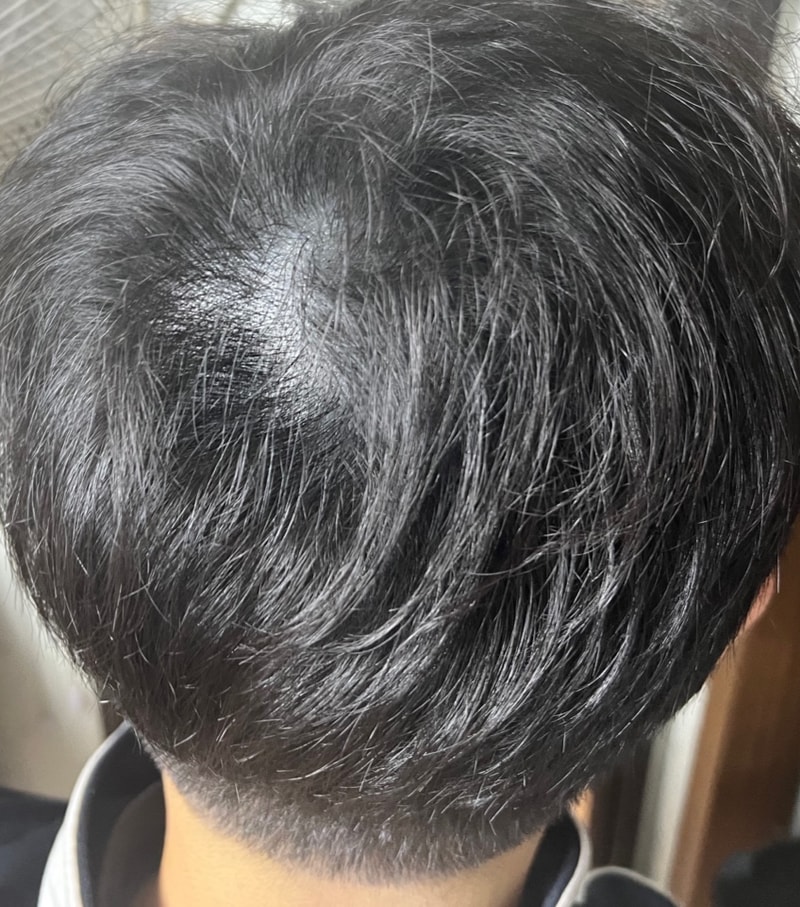 모재성 모발이식 4개월차 후기(비절개,무삭발)