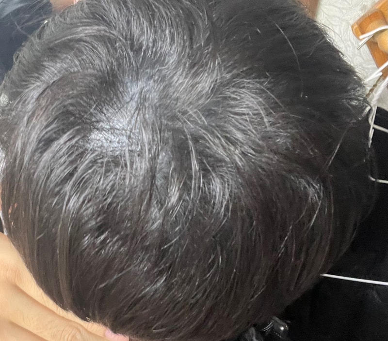 모재성 모발이식 8개월차 후기(비절개,무삭발)