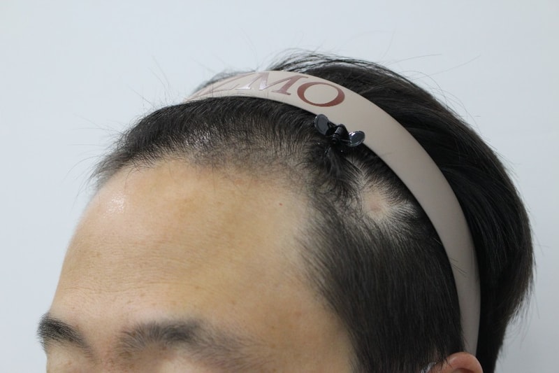B 수술전2.jpg
