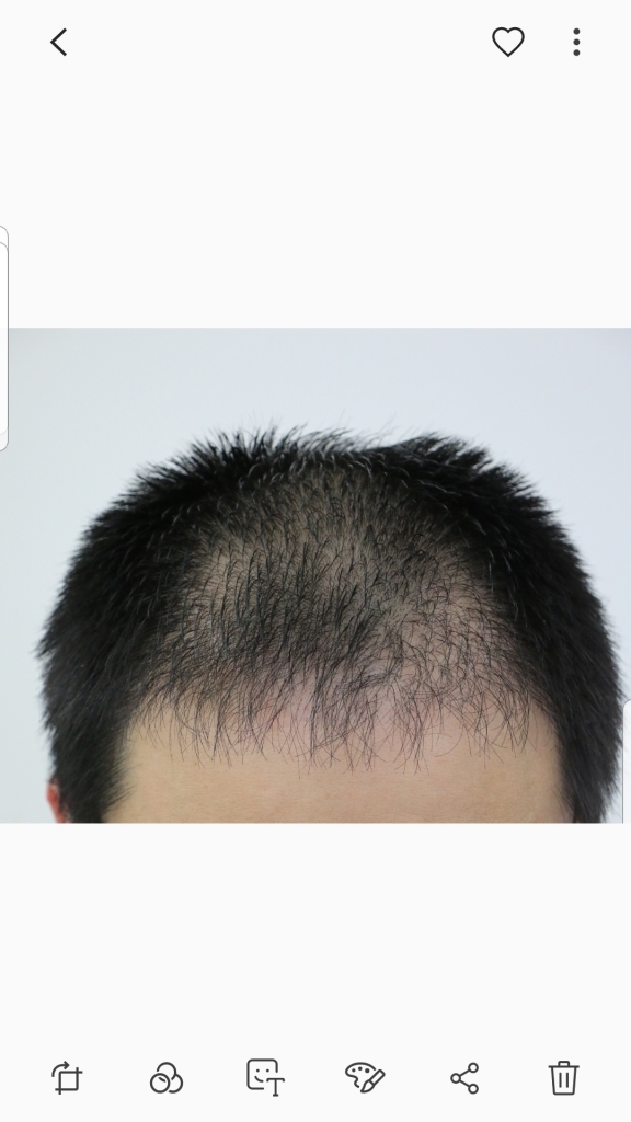 수술후 90일째입니다   좀 느린거같아 초조합니다