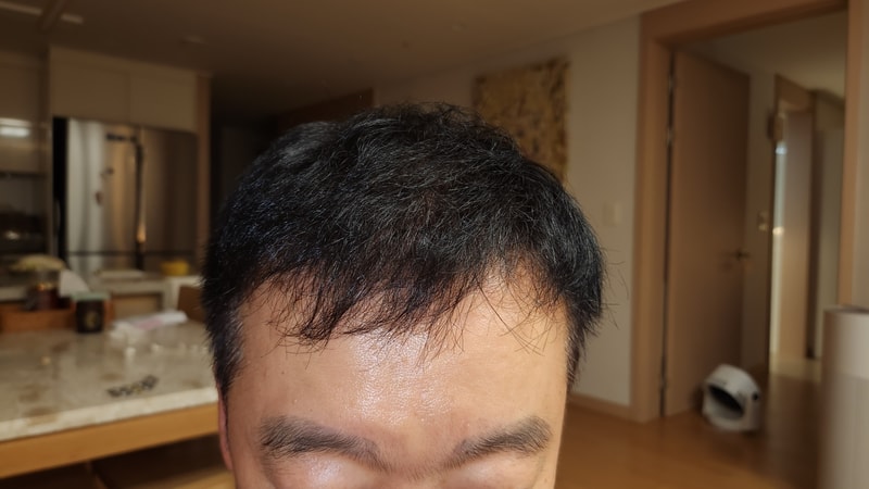 뉴헤어서울점 2000모낭 비절개 7개월차