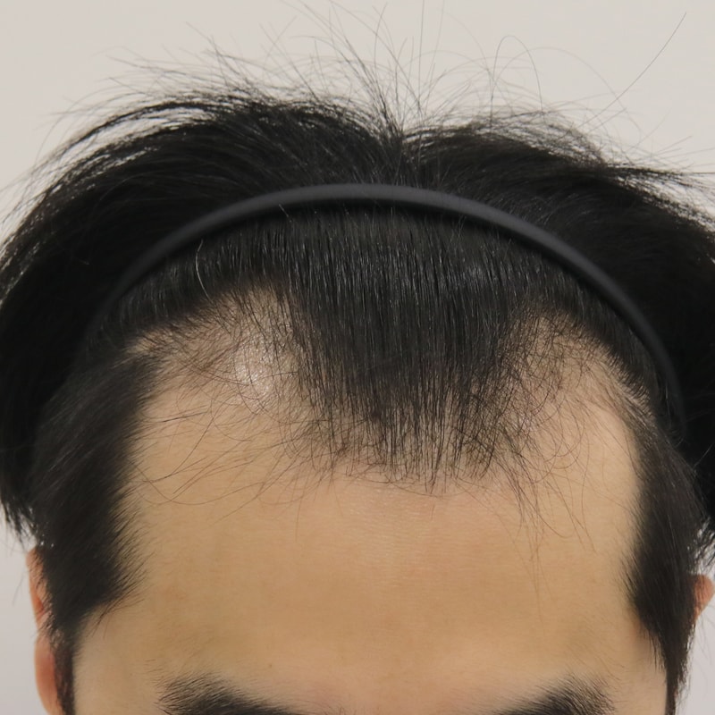 부산 맘모스헤어라인의원 4개월 경과 후기입니다!