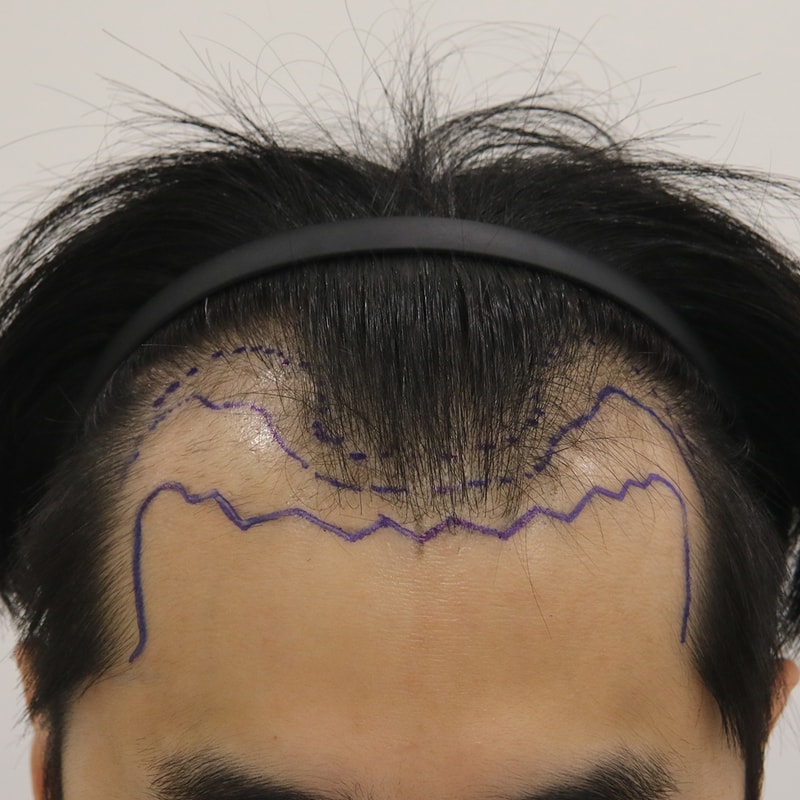 수술전디자인.jpg