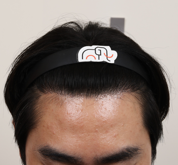 울산에서 찾아간 부산 맘모스 재수술 성공 후기(1년 1개월 최종 경과)