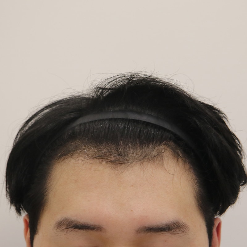 수술 전_전병옥님.jpg