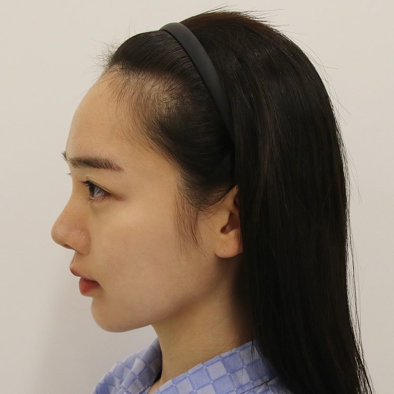 부산 여성 헤어라인교정 수술 당일 후기 [맘모스 부산점]