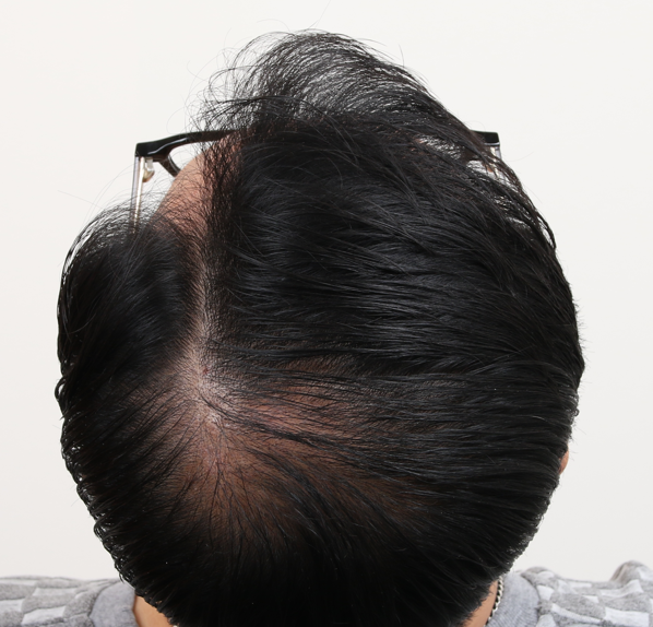 정수리 수술 후.png