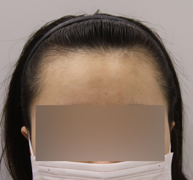 [맘모스헤어라인의원] 어느덧 수술한지도 7개월이 넘었네요~ 매직하고 왔어요