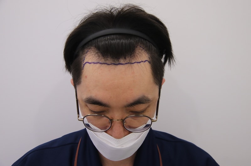 수술 5개월 경과. 맘모스에서 좋았던 점...