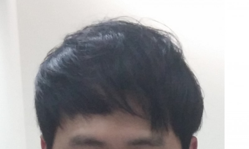 이식후 붕대제거 머리내림.png