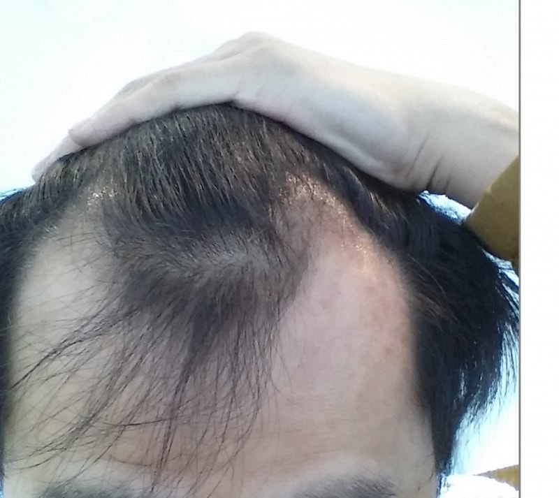 1300모낭 약 3개월 경과 (87일차)