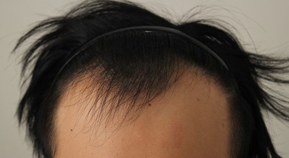 원스탑견적 받고 어제 수술했습니다.