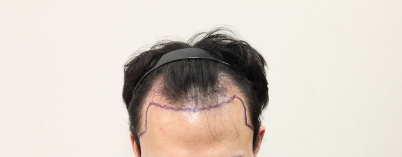NHI뉴헤어 비절개 2465모낭 이식1일차 입니다