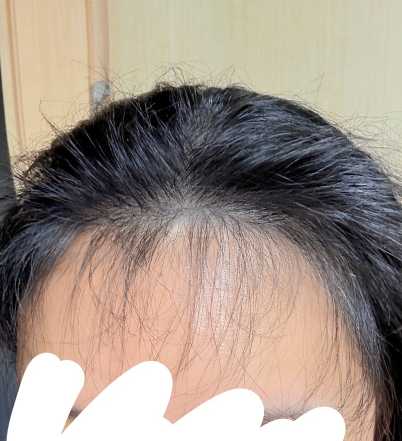 다나 4400모 극강 M자이마 여성 대량이식 후기  (유승현원장님)