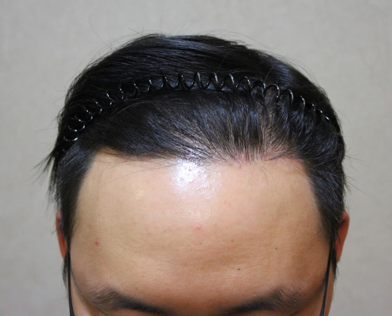 수술후09개월 1.jpg