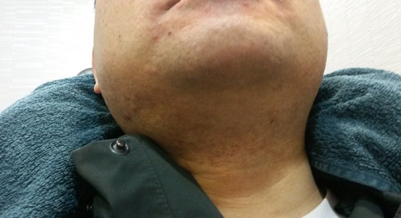수염 수술후(1).jpg