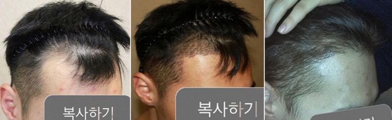 왼쪽 머리.jpg