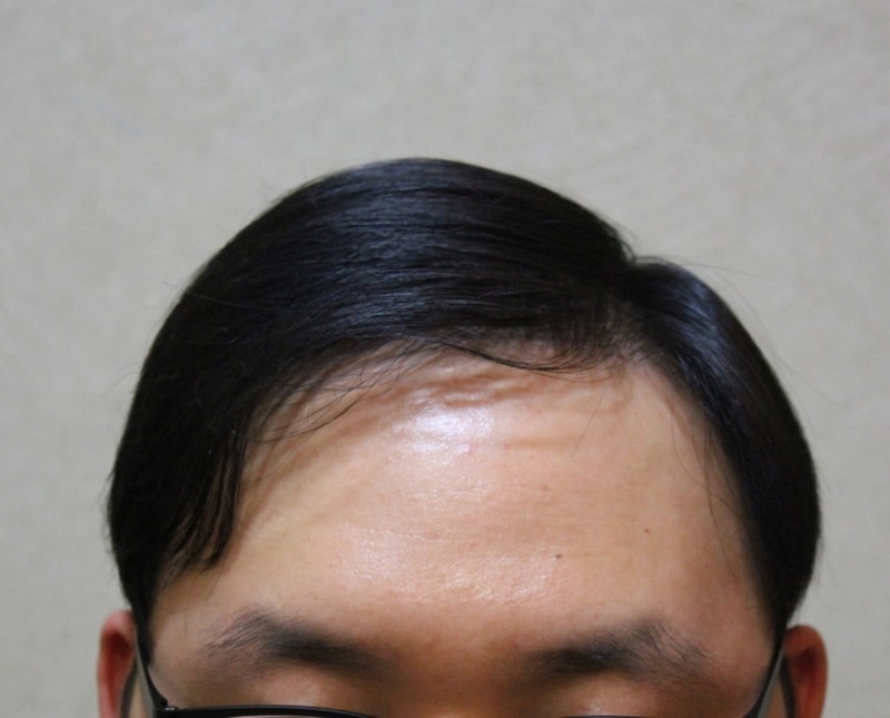 수술후09개월 2.jpg