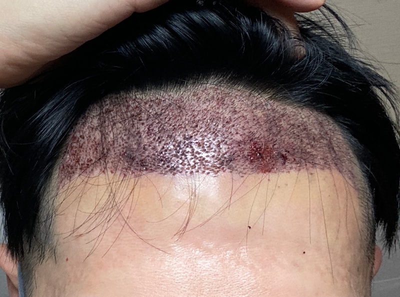 수술실패  결과불만족!! 모래 리터치 하는데 잠이 안옵니다.