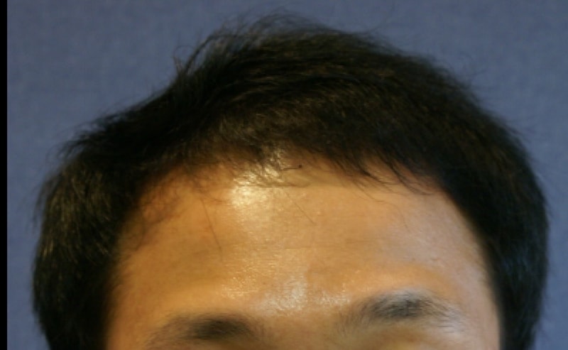 10년 수술 1년후 2011년 사진.PNG