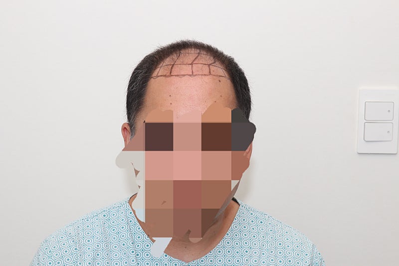 모발이식 3개월차 후기입니다!