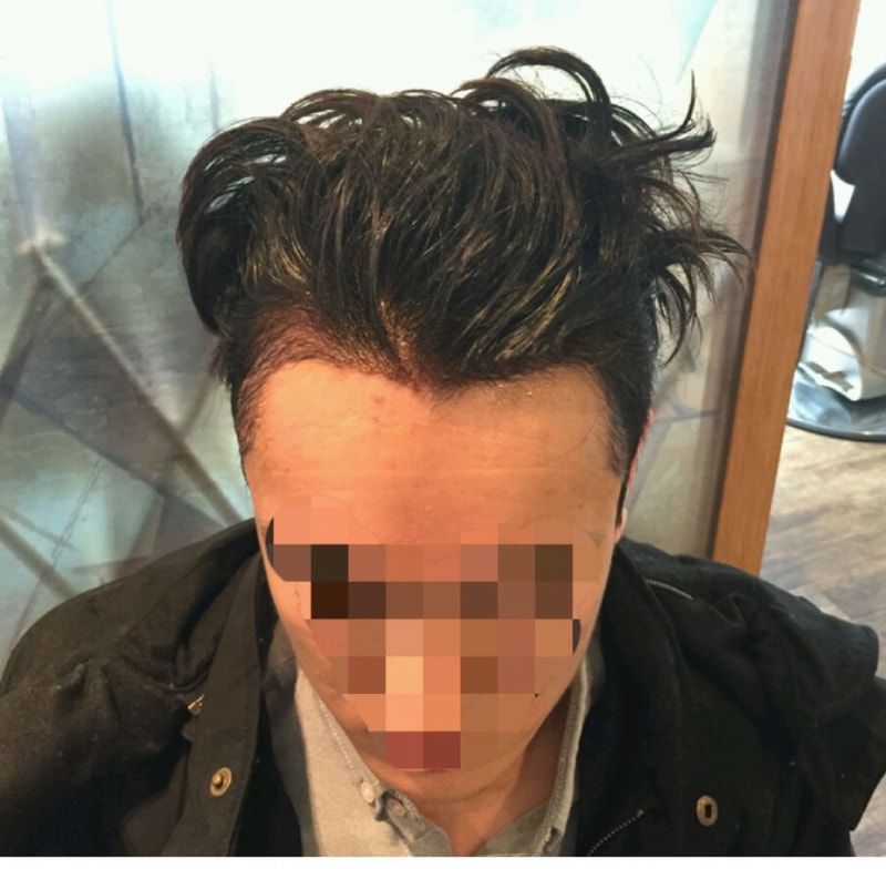 붕대풀고 (11).jpg