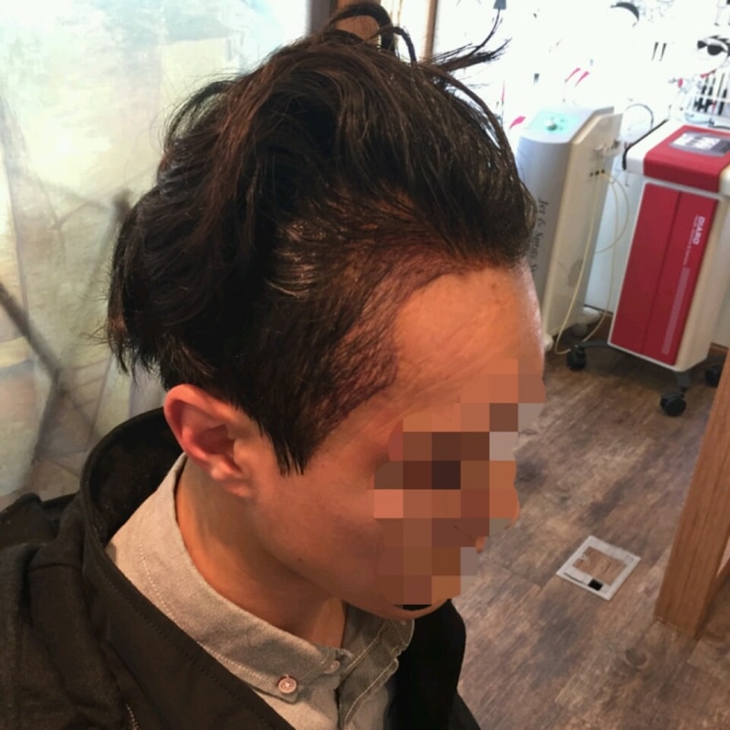 붕대풀고 (3).jpg