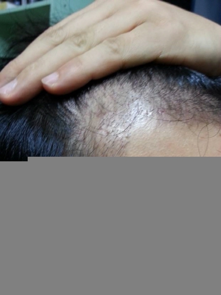 크기변환_8_수술 91일차.jpg