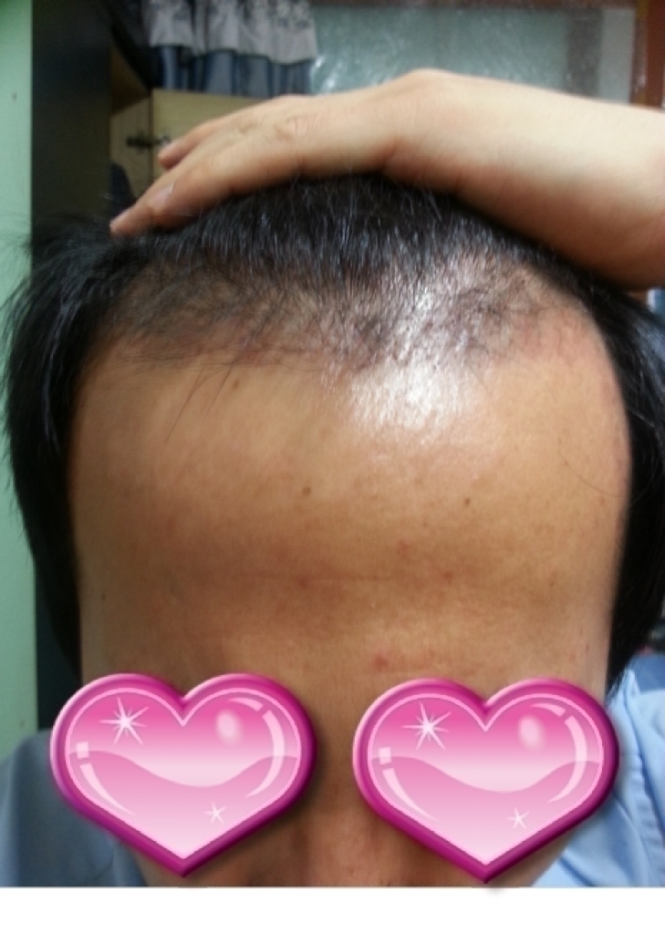 크기변환_모발이식 60일  정면.png