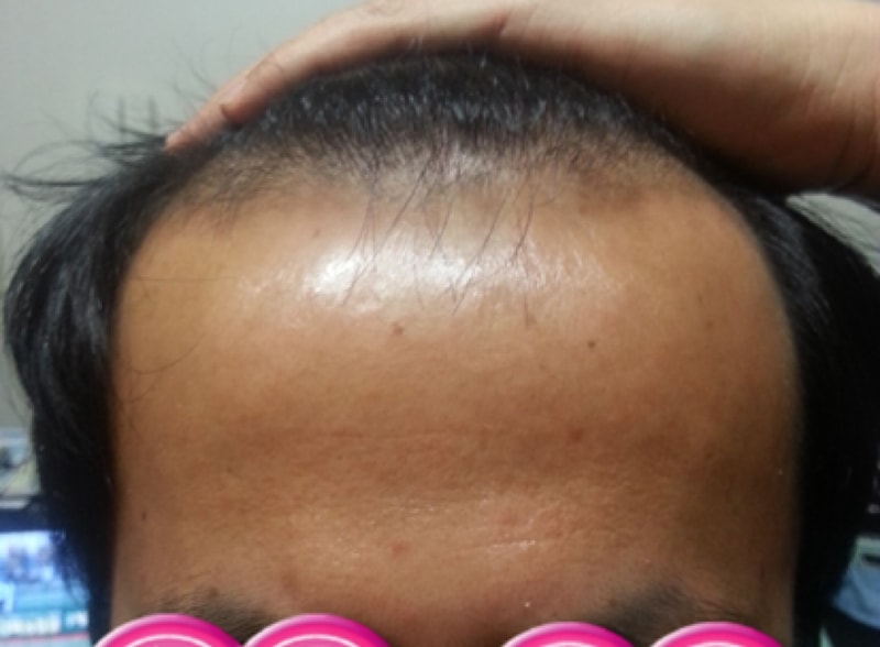 이식전 정면.png