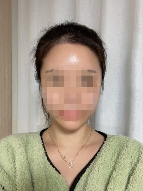 모모성형외과의원 비절개 모발이식 2370모 90일 경과 후기