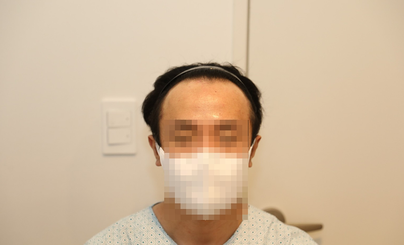 모발이식 2000모낭 후기