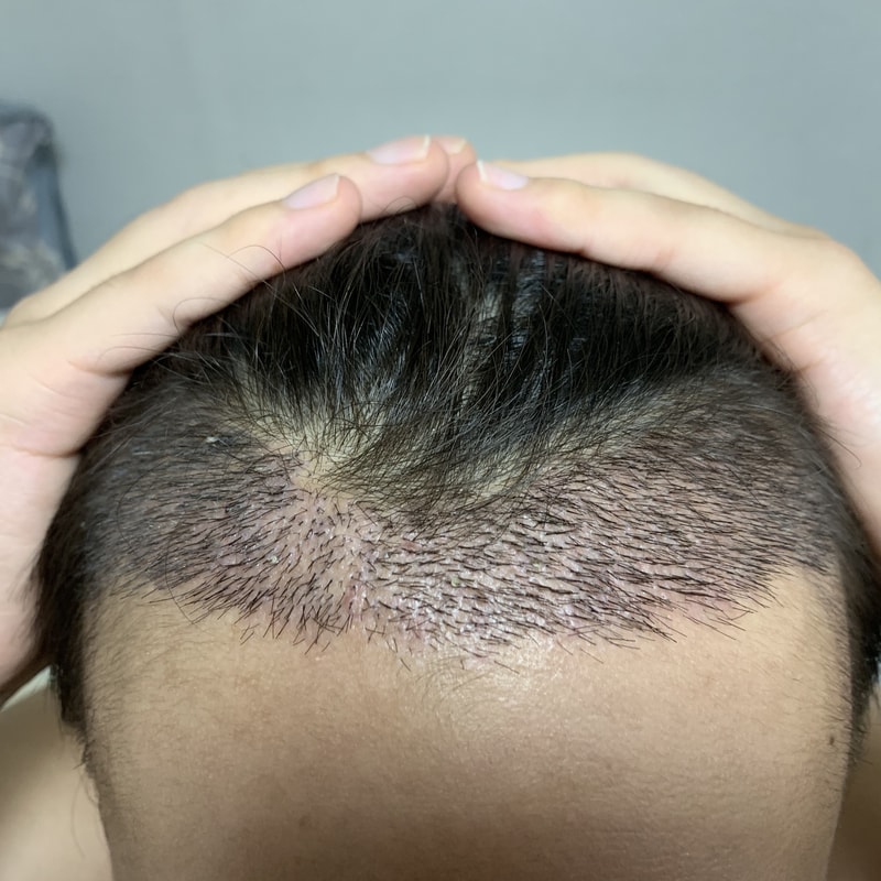 무삭발 비절개 2000모낭 18일차
