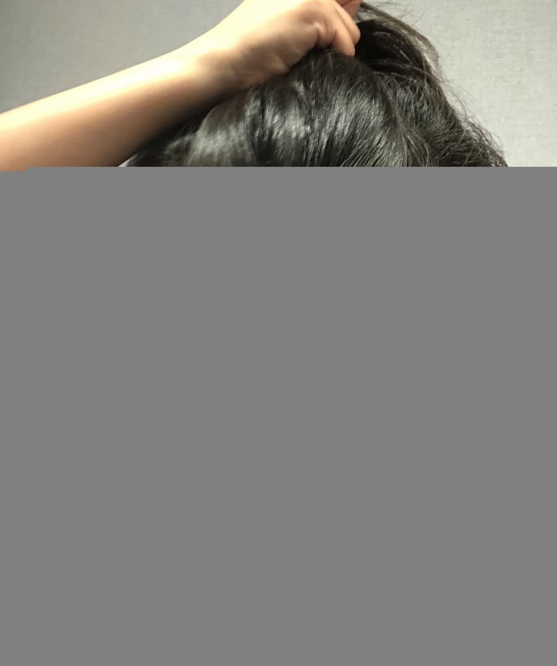 다나성형외과 절개 4000모 수술받았어요 (~15일/긴글주의)