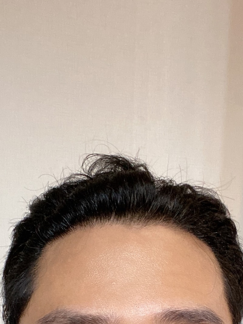 다나 비절개 1년입니다
