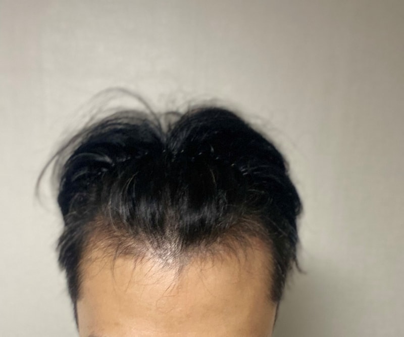 다나 엠자 비절개 암흑기 선방 중