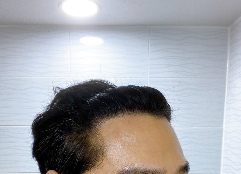 295일, 다나 비절개 모발이식