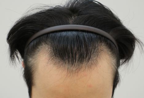 비절개 박스컷 1200모낭