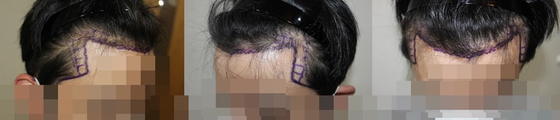 비절개 1200모낭 한달지나네요~