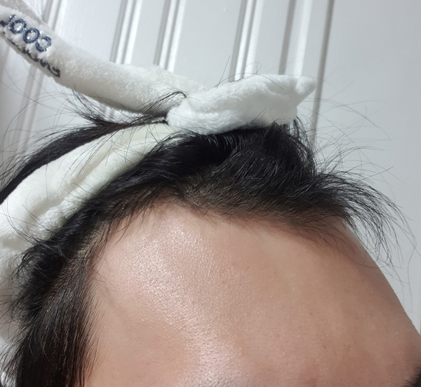 비절개 1700모낭 4달차 사진 공유합니다.